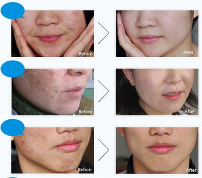 Crema Facial Antiacné